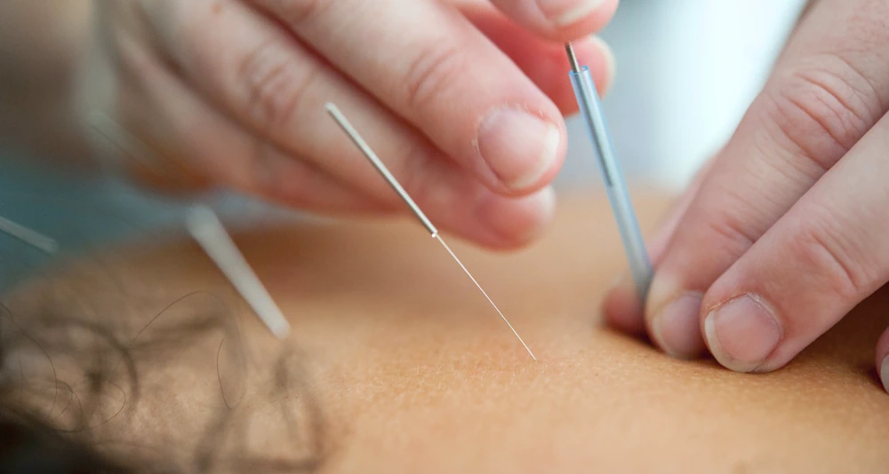 Akupunkturbehandlung mit Nadeln